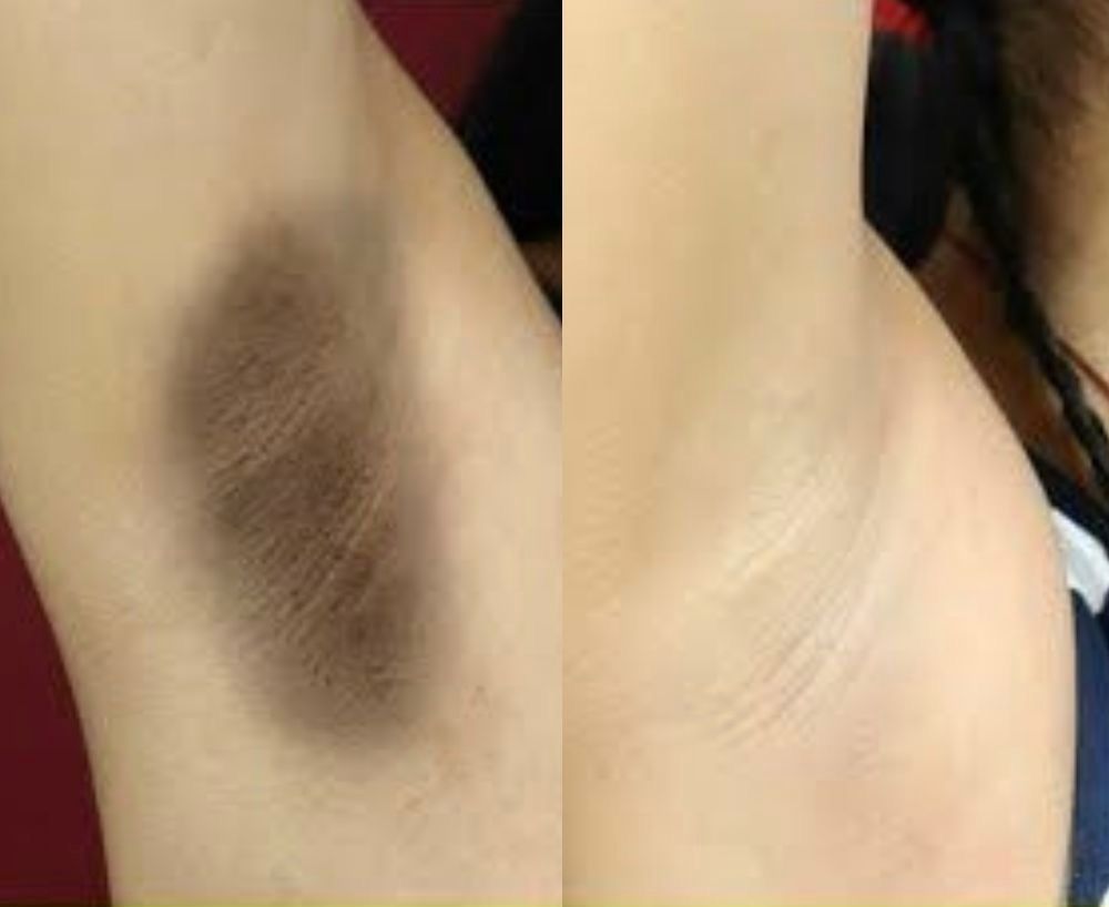 imagem do procedimento clareamento